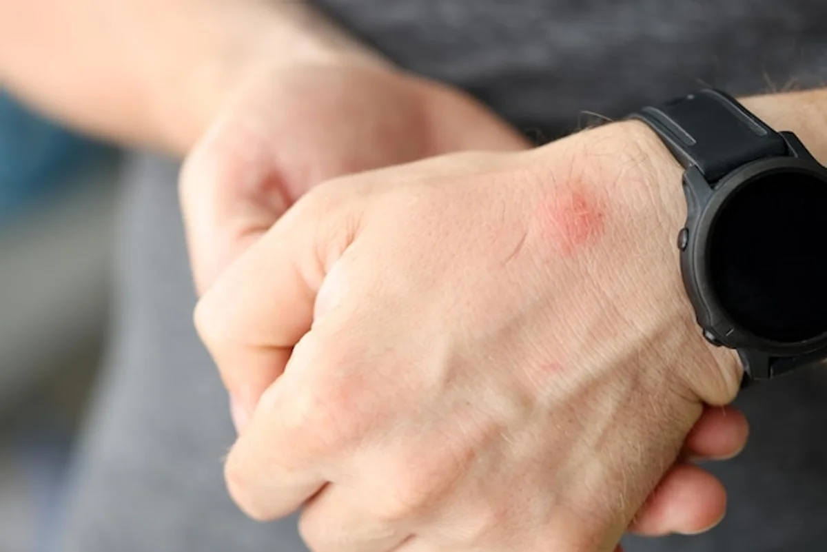 smartwatch skin allergy close up