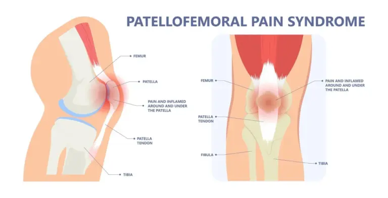 running knee injury Fersenlauf problem